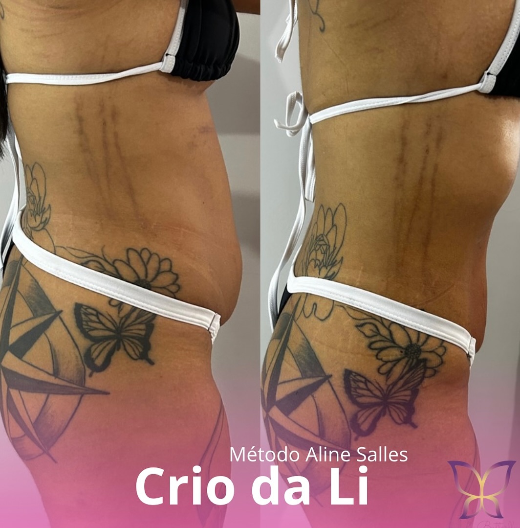 Resultado real de tratamento corporal no Studio Butterfly