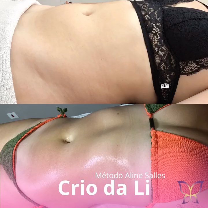 Resultado real de cuidado corporal no Studio Butterfly